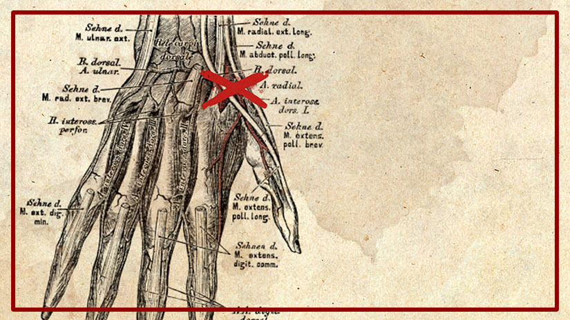 Bieten eine Möglichkeit mehr als gedacht: Die Arterien am Handrücken (Abb. aus "Die descriptive und topographische Anatomie des Menschen" von Carl Heitzmann, 1870)